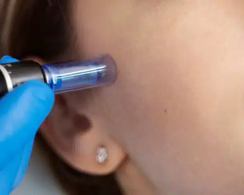 Patient undergoing microneedling procedure -